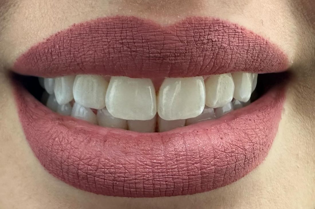 Dientes blancos resultado